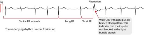 Atrial fibrillation: ECG, classification, causes, risk factors ...