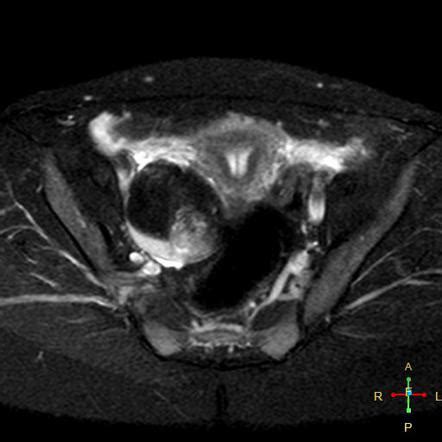 Ovarian dermoid cyst | Image | Radiopaedia.org