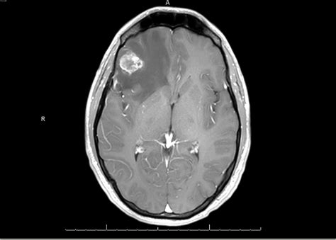 Brain Metastases as Presenting Feature in 'Burned Out' Testicular Germ ...