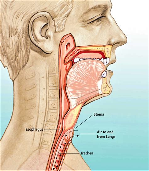 Total or partial laryngectomy procedure, complications, risks & recovery