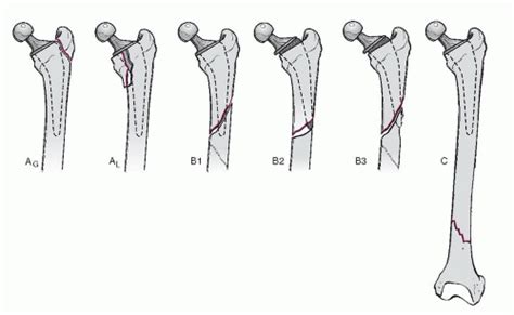 Periprosthetic Fractures | Musculoskeletal Key