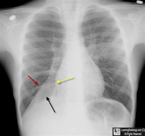 Condition Specific Radiology: Atelectasis - Stepwards