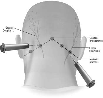 Nerve Blocks in the Treatment of Headache - Neurotherapeutics