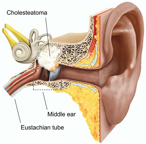 Cholesteatoma | ENT Condition | OneWelbeck