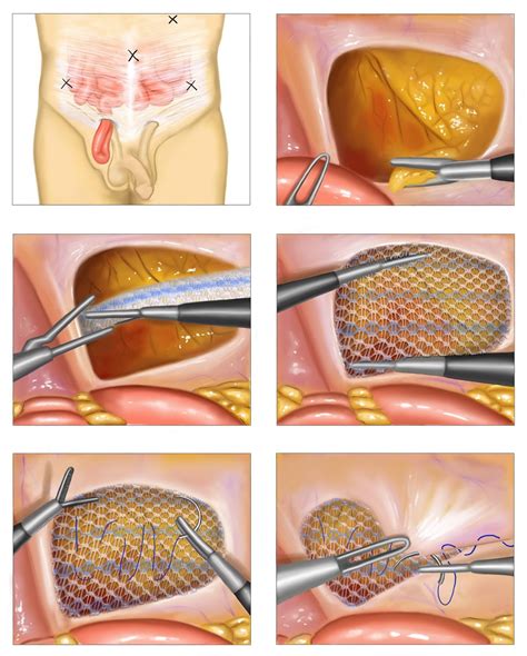 The Health Hub: Inguinal Hernia Repair - Overview