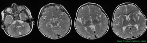 Dr Balaji Anvekar's Neuroradiology Cases: Leigh syndrome MRI