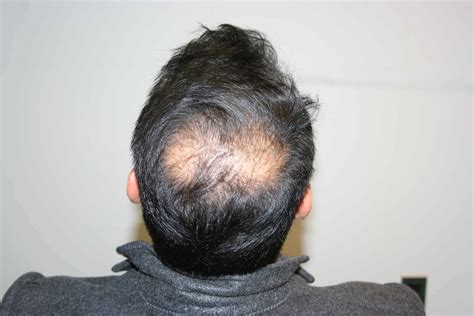 Male Hair Loss New York | Men’s Hair Loss Causes, Treatment & Diagnosis