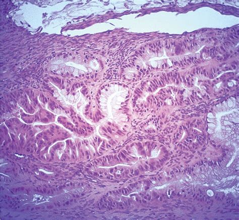 Epithelial ovarian cancer | Oncohema Key