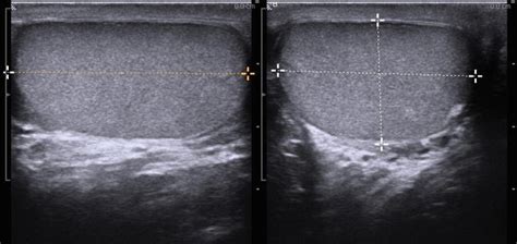 Normal Epididymis Ultrasound