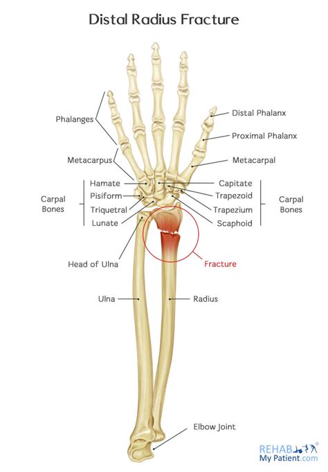 Distal Radius Fracture | Rehab My Patient