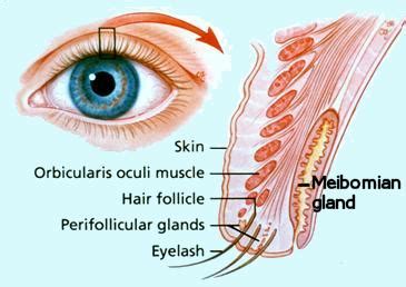 Meibomian gland disease (MGD) (Evaporative dry eyes) – Prevent, avoid ...