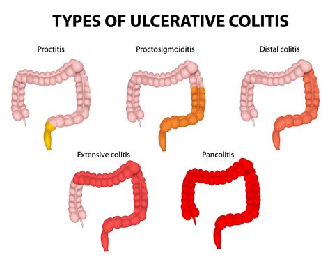 Ulcerative Colitis | Colon & Rectal Surgical Specialists