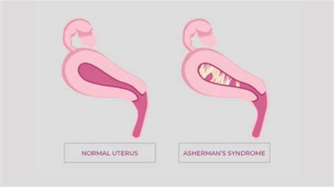 Asherman's Syndrome Treatment In Delhi | Uterine Adhesions