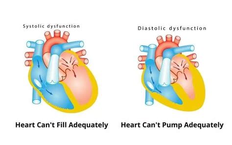 Systolic Heart Failure vs Diastolic Heart Failure: Symptoms, Diagnosis ...