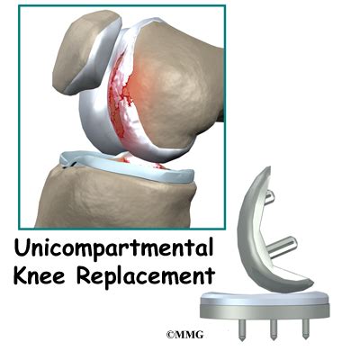 Unicompartmental Knee Replacement | eOrthopod.com