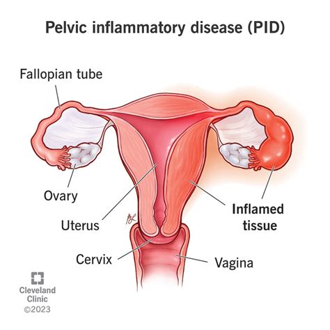 Pelvic Inflammatory Disease (PID): Symptoms & Treatment