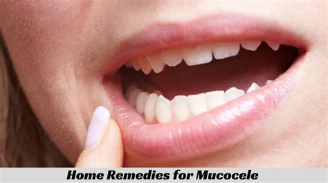 How to Get Rid of Mucocele (Mucous Cyst)