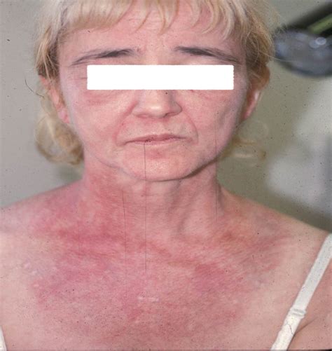 Dermatomyositis - Dermatology Advisor