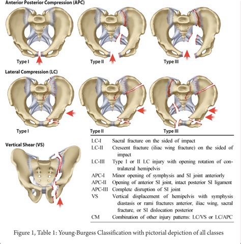 Classification of Pelvis and Aetabulum Injuries – Trauma International