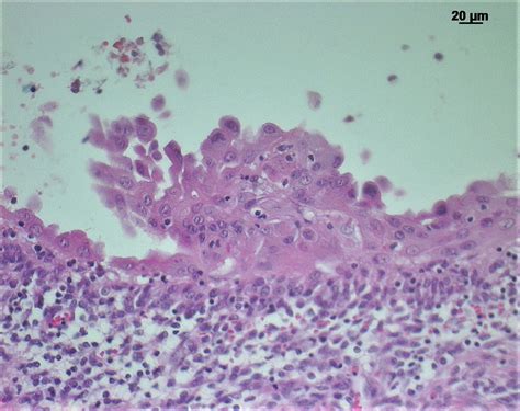 PB - Reactive mesothelial hyperplasia mimicking mesothelioma in an ...