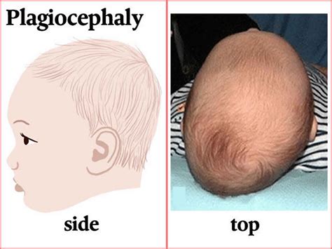 Plagiocephaly causes, symptoms, diagnosis & treatment