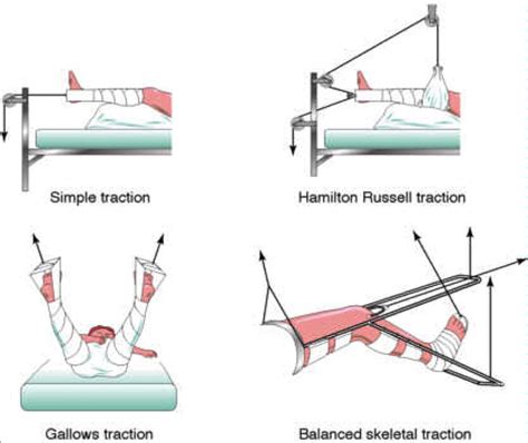 Traction Worksheets