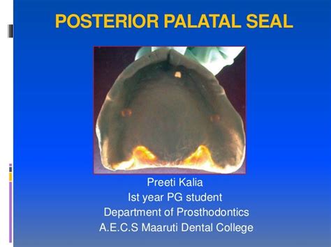 posterior palatal seal ppt