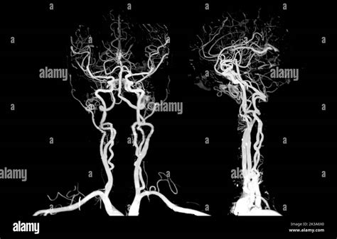 Brain artery angiogram hi-res stock photography and images - Alamy