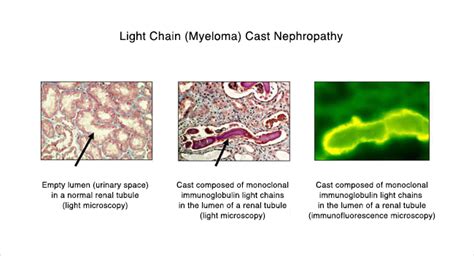 Light Chain Deposition Disease | UNC Kidney Center