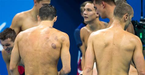 What Are the Purple Dots on Michael Phelps? Cupping Has an Olympic ...