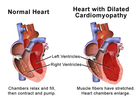 Dilated Cardiomyopathy (DCM) – CIDG