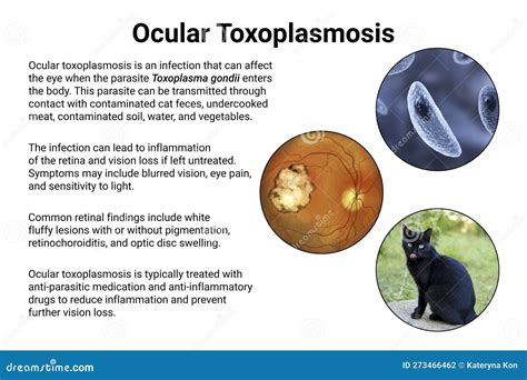 Ocular Toxoplasmosis, Retinal Scar Caused By A Toxoplasma Gondii ...