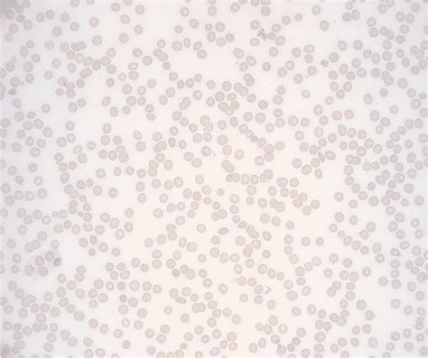 Transient Acquired Amegakaryocytic Thrombocytopenia in the Setting of ...