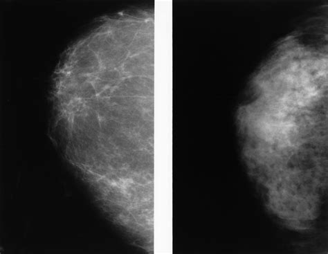 What does a breast cancer tumor look like on ultrasound ️Updated