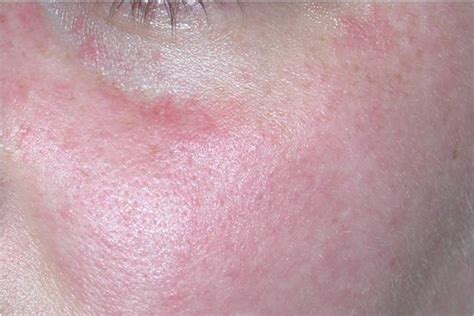 Azelaic Acid 15% Gel for Reduction of Inflammatory Rosacea Lesions