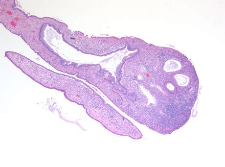 Cervix Image Atlas - Non-Neoplastic Lesions and Benign Neoplasms ...