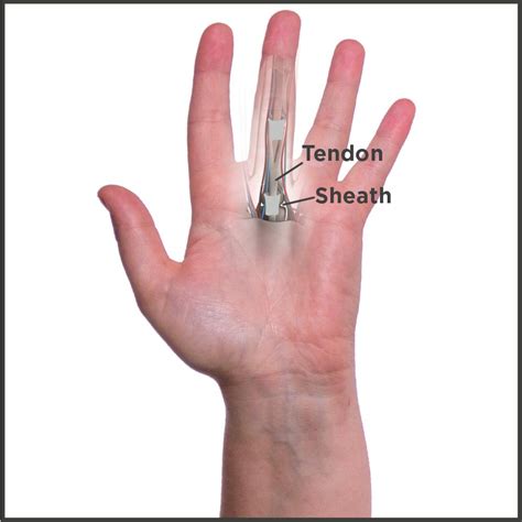 Trigger Finger Treatment | Solutions & Relief For Trigger Finger