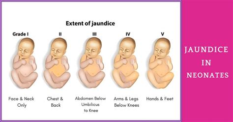 Why are newborns prone to jaundice? | Sri Ramakrishna Hospital