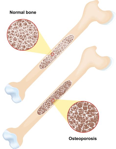 How Does Osteoporosis Weaken Bones