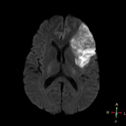 Ischemic Stroke Mri