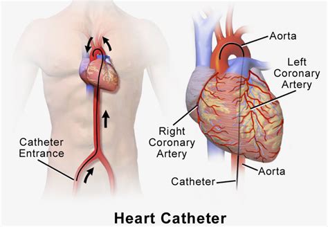 Cardiac Catheterization Procedure - The Steps, Duration, Heart Cath Risks