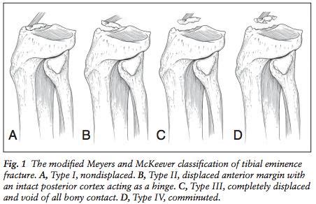 Tibial Eminence Fracture - Pediatrics - Orthobullets