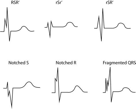 Other ECG changes in ischemia and infarction – ECG learning