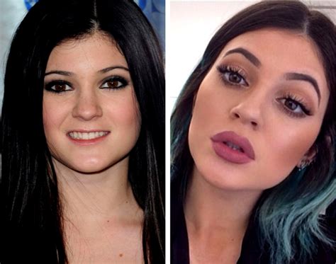 Pictures : Should I Get Lip Fillers? - Kylie Jenner Lip Fillers Before ...