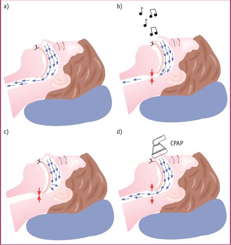 Figure 1 from Principles of CPAP and auto-adjusting CPAP devices ...