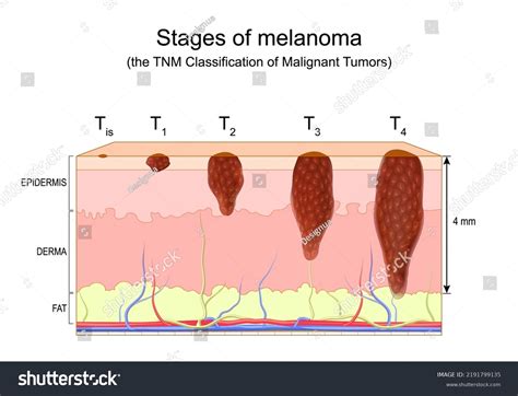 「黒色腫の病期。悪性腫瘍のTNM分類。皮膚癌の転移。悪性黒色腫。ベクター図」のベクター画像素材（ロイヤリティフリー） 2191799135 ...