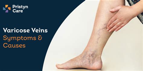 What Causes Varicose Veins? - Pristyn Care