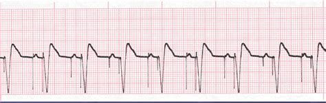 Pacemaker Rhythms: ECG class, criteria, tracings ...