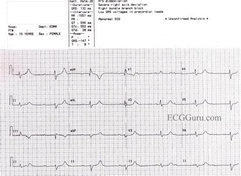 Prolonged QTc interval | ECG Guru - Instructor Resources