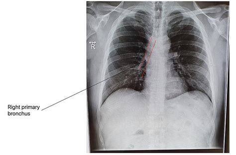 Chest X Ray Bronchitis Vs Pneumonia